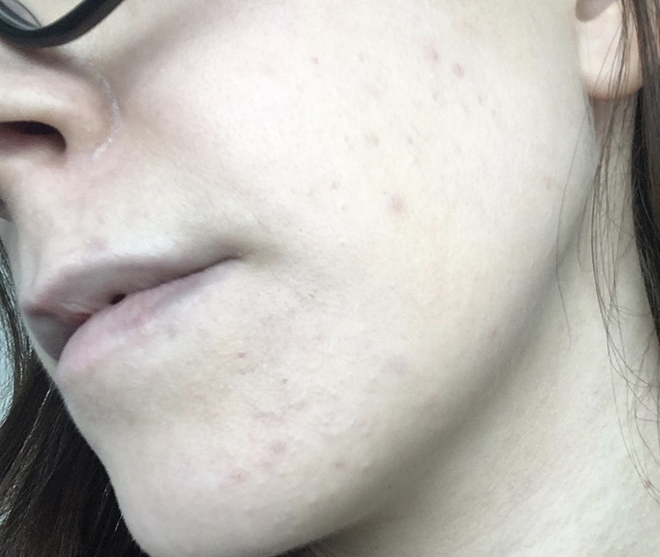 Hormonal Acne and a Dairy Free Diet